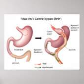 Roux-en-Y Gastric Bypass poster (Voorkant)