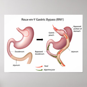 Roux-en-Y Gastric Bypass poster