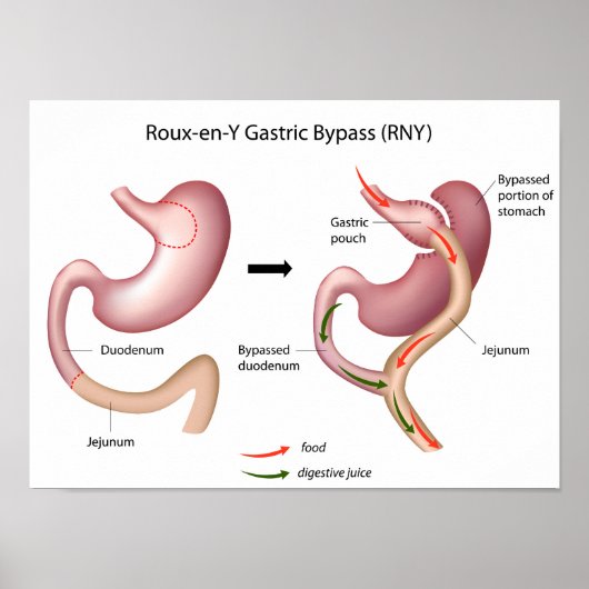 Roux-en-Y Gastric Bypass poster (Voorkant)