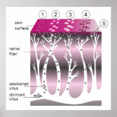 Schema van de progressie van gordelroos op de huid poster (Voorkant)