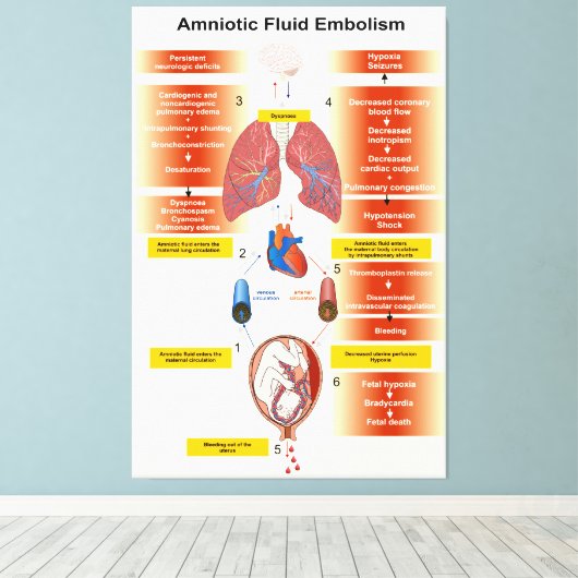 Schema van een amniotisch vochtembolie AFE Canvas Afdruk (Insitu (Houten vloer))