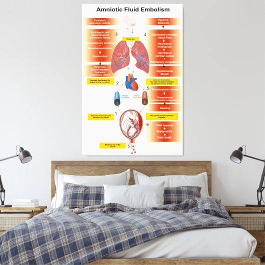 Schema van een amniotisch vochtembolie AFE Canvas Afdruk (Insitu (Slaapkamer))