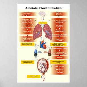 Schema van een amniotisch vochtembolie AFE Poster