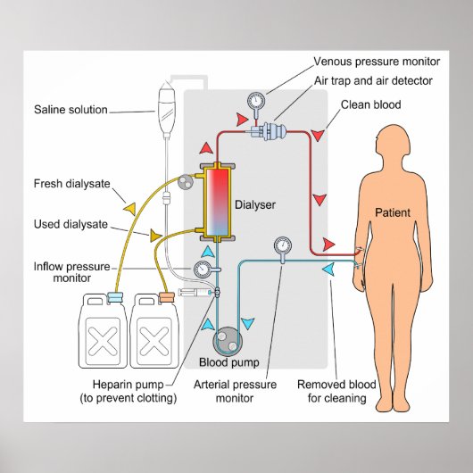 Schema van een hemodialyse Medische Behandeling Poster (Voorkant)