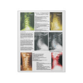 Scheur uit pad Cervical Spinal Degeneration Notitieblok (Linkerzijde)