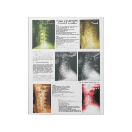Scheur uit pad Cervical Spinal Degeneration Notitieblok (Linkerzijde)