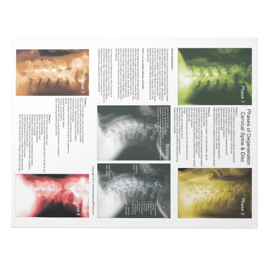 Scheur uit pad Cervical Spinal Degeneration Notitieblok (Voorkant)