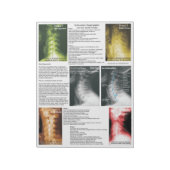 Scheur uit Pad subluxe cervicale degeneratie Notitieblok (Linkerzijde)