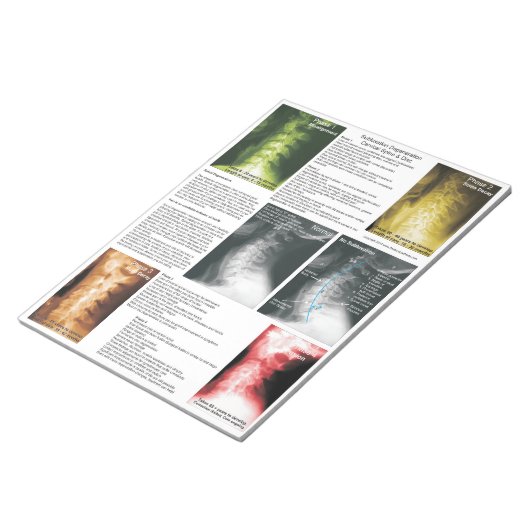 Scheur uit Pad subluxe cervicale degeneratie Notitieblok (Schuin)