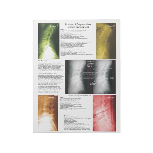 Scheur uit poot Lumbar Spinale degeneratie Notitieblok (Linkerzijde)