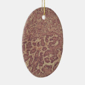 Schildkliercellen met kanker keramisch ornament (Rechts)