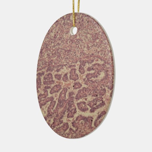 Schildkliercellen met kanker keramisch ornament (Links)