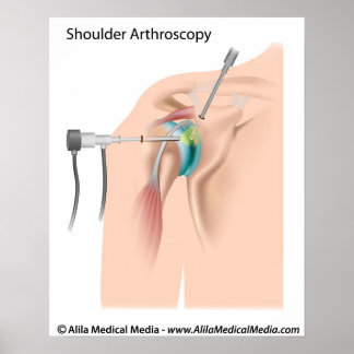 Schouder-artroscopiediagram. Poster