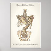 Scoliosis Spine Poster (Voorkant)