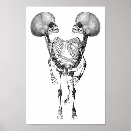 Siamese met tweelingen Anatomie Skeletons kunst Poster (Voorkant)
