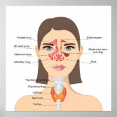 Sinusitis Poster (Voorkant)