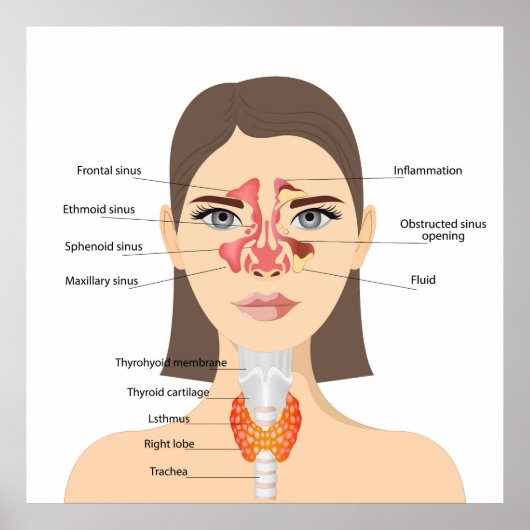 Sinusitis Poster (Voorkant)