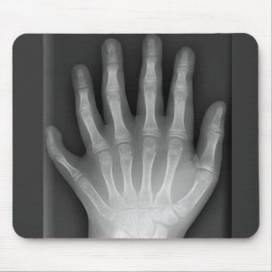 Six Fingered Hand, Medical Rarity, X-Ray Muismat