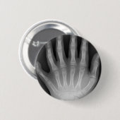 Six Fingered Hand, Medical Rarity, X-Ray Ronde Button 5,7 Cm (Voorkant /achterkant)