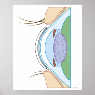Soft Contact Lens Poster