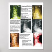 Spaans Poster voor cervicale Spinale degeneratie (Voorkant)