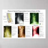 Spinal Degeneration Cervical Spine Chiropractic Poster (Voorkant)