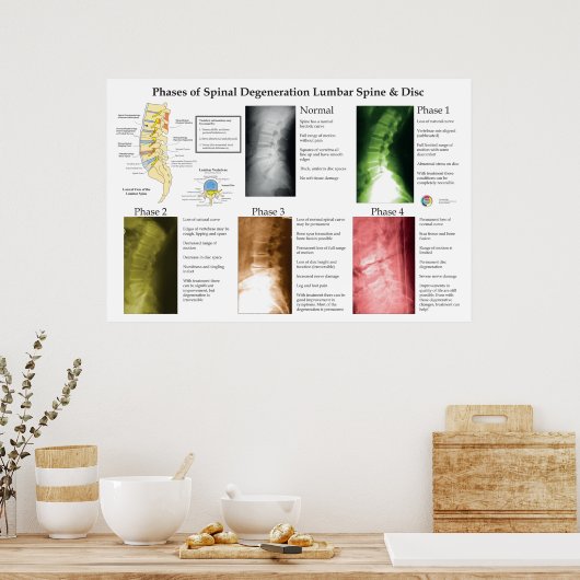 Spinal Degeneration Lumbar Spine Chiropractic Poster (Keuken)