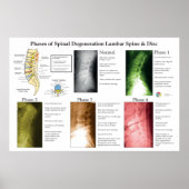 Spinal Degeneration Lumbar Spine Chiropractic Poster (Voorkant)