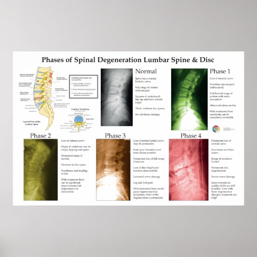 Spinal Degeneration Lumbar Spine Chiropractic Poster (Voorkant)