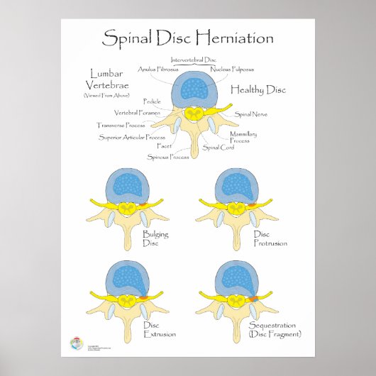 Spinale schijfherniatie Poster Medische Poster (Voorkant)