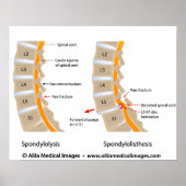 Spondylolysis and spondylolisthesis, labeled poster (Voorkant)