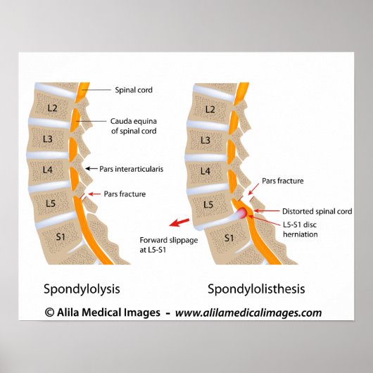 Spondylolysis and spondylolisthesis, labeled poster (Voorkant)