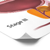 Stappen prostaatkanker Poster (Hoek)