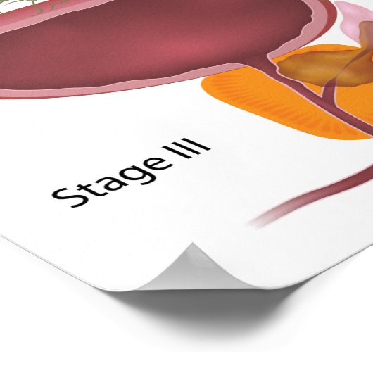 Stappen prostaatkanker Poster (Hoek)