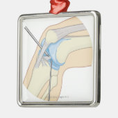 Stijve endoscopie metalen ornament (Links)