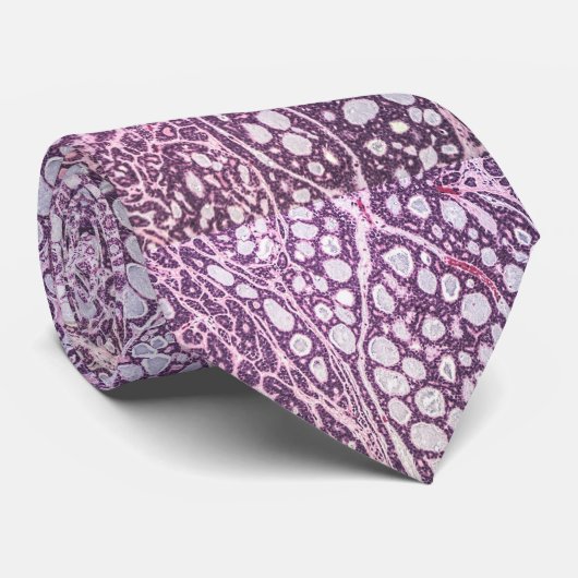 Stropdas met adenoïd-cystisch carcinoom (Opgerold)