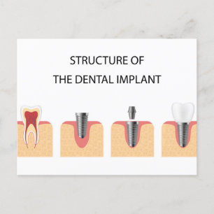 Structuur van het tandheelkundig implantaat aankondigingskaart