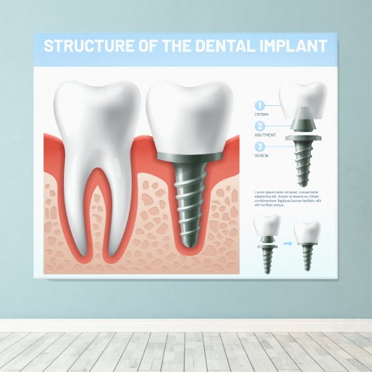 Structuur van het tandheelkundig implantaat canvas afdruk (Insitu (Houten vloer))