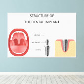 Structuur van tandheelkundig implantaat canvas afdruk (Insitu (Houten vloer))