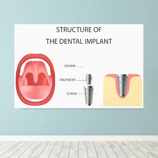 Structuur van tandheelkundig implantaat canvas afdruk (Insitu (Houten vloer))