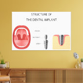 Structuur van tandheelkundig implantaat canvas afdruk (Insitu (Woonkamer))