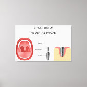 Structuur van tandheelkundig implantaat canvas afdruk (Voorkant)