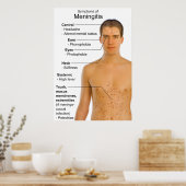 Symptomen Grafiek van ontsteking Meningitis Poster (Keuken)
