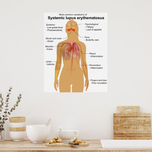 Symptoomdiagram van systemische lupus Erythematosu Poster (Keuken)