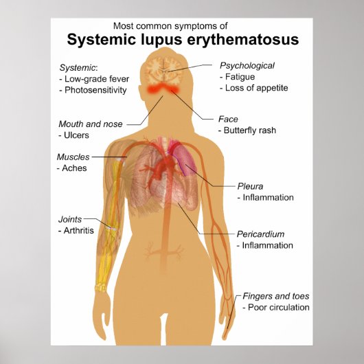 Symptoomdiagram van systemische lupus Erythematosu Poster (Voorkant)