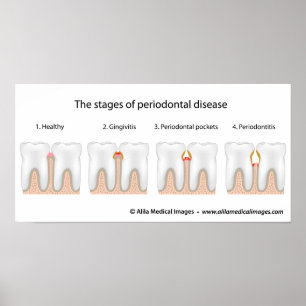 Tandaandoening Periodontale Poster