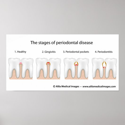 Tandaandoening Periodontale Poster (Voorkant)