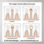 Tandaandoening Periodontale Poster (Voorkant)