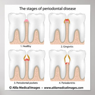 Tandaandoening Periodontale Poster