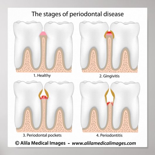 Tandaandoening Periodontale Poster (Voorkant)